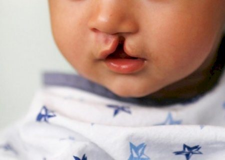 Programa ‘MS Saúde – Mais Saúde, Menos Fila’ realiza primeira cirurgia de correção de fissura lábio-palatal